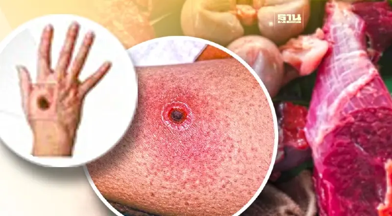 พบ“โรคแอนแทรกซ์” ในลาว จากการกินเนื้อวัว – ควายดิบ คุมเข้มลักลอบนำเข้า