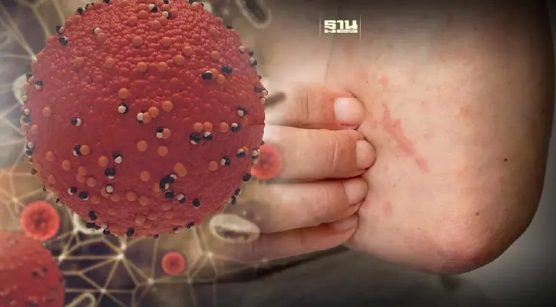 โรคหัดในผู้ใหญ่ อันตรายอาจถึงขั้นเสียชีวิต อาการ-วิธีรักษา