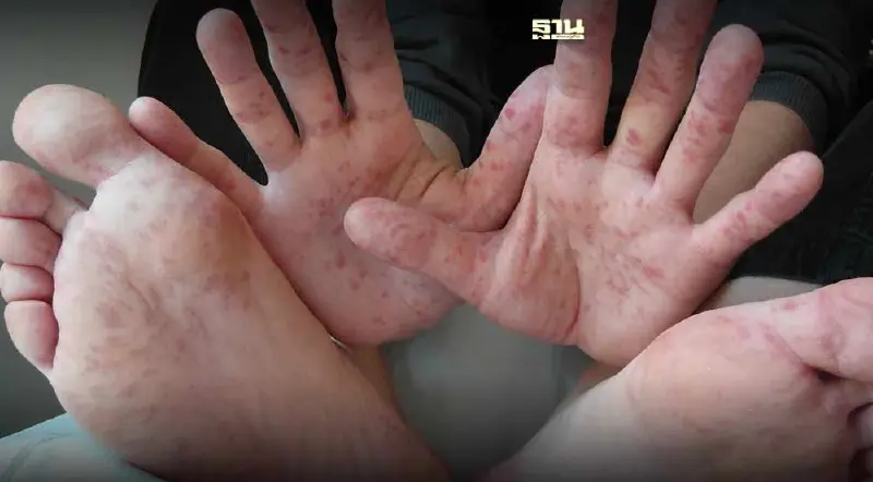 "หมอยง" เตือนโรคมือ เท้า ปากแนวโน้มระบาดพุ่งในเด็ก หลังไร้ภูมิต้านทาน