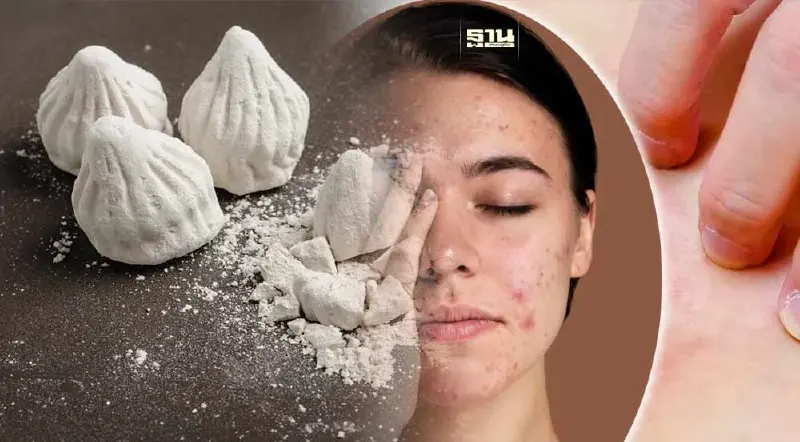 วิธีรักษา อาการแพ้น้ำ แพ้ดินสอพอง เกิดผื่นแดง สิวเห่อ หลังเล่นน้ำสงกรานต์