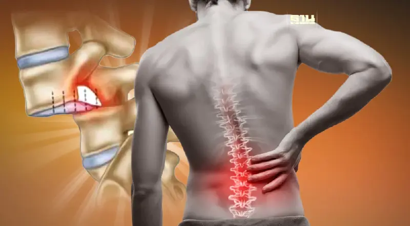 โรคกระดูกสันหลังเคลื่อน เกิดจากอะไร อาการและการรักษา