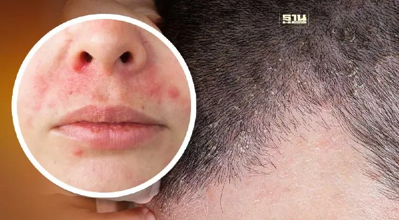 ขึ้นผื่นแดง แสบคัน อย่าคิดว่าแค่ "ภูมิแพ้" อาจเป็น "โรคเซ็บเดิร์ม" ขึ้นผื่นแดง แสบคัน อย่าคิดว่าแค่ "ภูมิแพ้" อาจเป็น "โรคเซ็บเดิร์ม"