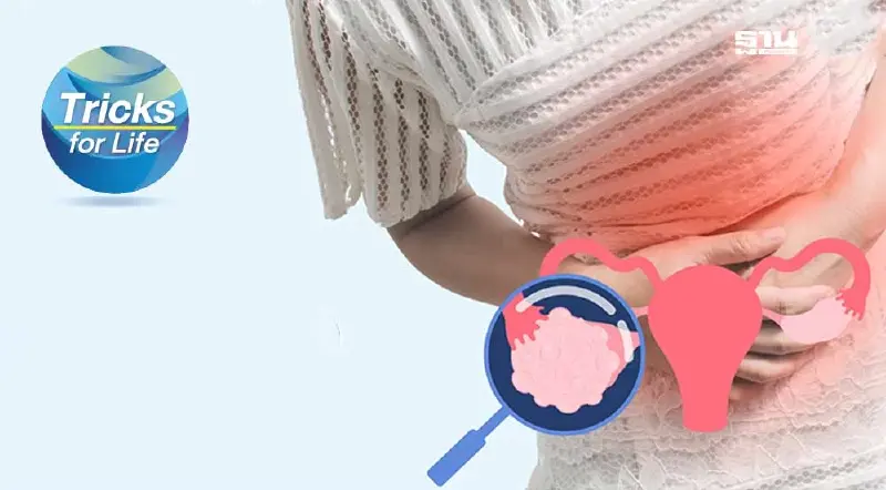 อย่ามองข้าม “มะเร็งรังไข่” ภัยเงียบที่ผู้หญิงต้องระวัง