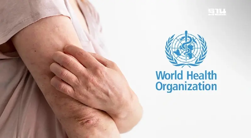 WHO ประกาศให้ ฝีดาษลิง เป็นภาวะฉุกเฉินด้านสาธารณสุขระดับโลก