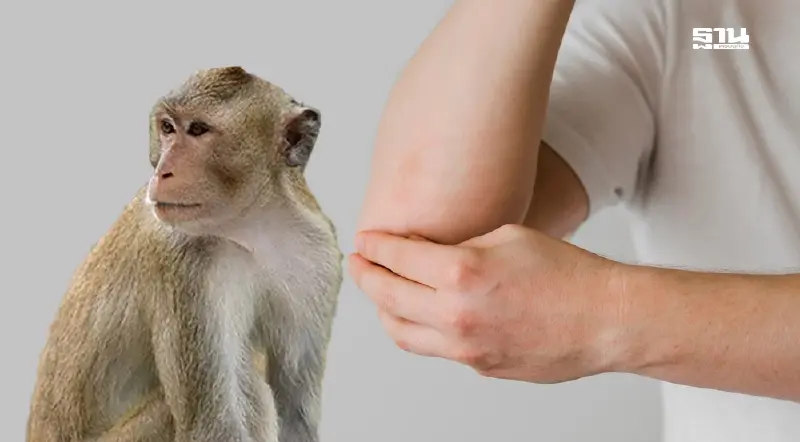 อาการ ฝีดาษวานร ที่ควรระวัง เช็คกลุ่มเสี่ยง ช่องทางการติดต่อ 