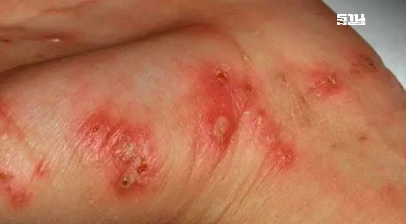 โรคเมลิออยโดสิส ภัยเงียบในฤดูฝน กรมควบคุมโรคเตือนกลุ่มเสี่ยง