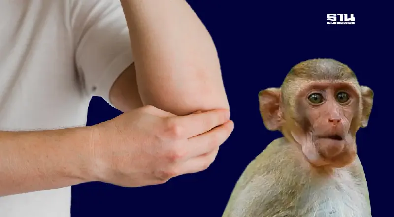 สธ.ยัน​ ป่วยติดเชื้อ-สัมผัสใกล้ชิด​ ฝีดาษวานร​ เข้าระบบเฝ้าระวังทุกคน​