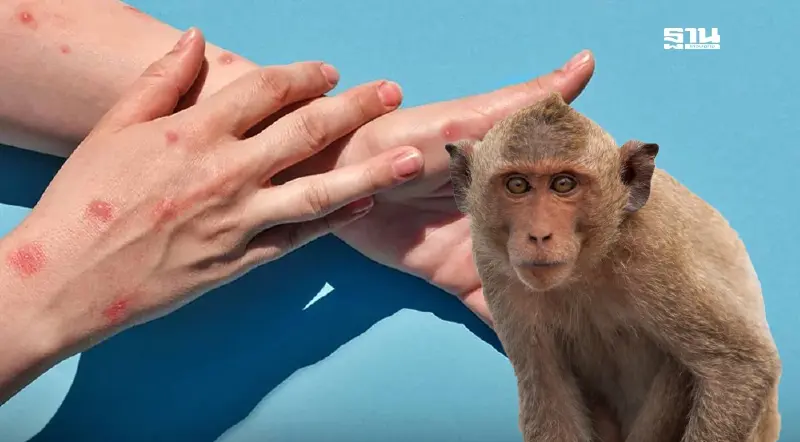 เปิดแผนรับมือ "ฝีดาษวานร" กรมควบคุมโรค พร้อมรับมือทุกสนามบิน