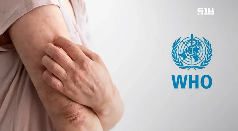 จับตา​ WHO​ เตรียมยกระดับภาวะฉุกเฉิน​ โรคฝีดาษวานร​