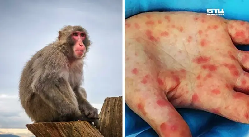 ฝีดาษลิงยังน่ากลัว ไทยเตรียมนำเข้าวัคซีนรุ่น 3 รับมือการระบาด