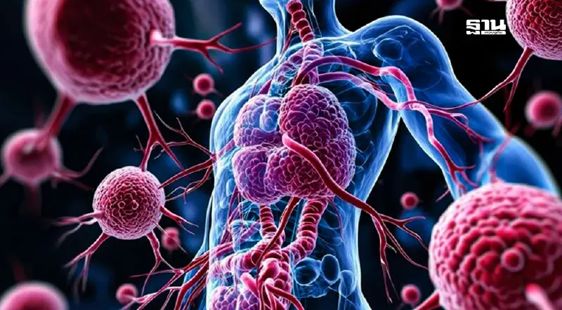 เตือนภัย มะเร็งต่อมน้ำเหลืองติดอันดับ 5 ของไทย รู้ทัน รับมือได้ เตือนภัย มะเร็งต่อมน้ำเหลืองติดอันดับ 5 ของไทย รู้ทัน รับมือได้