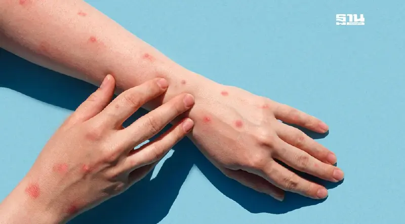 มีคู่นอนมากกว่า 1 คน เสี่ยงสูงติดเชื้อ “โรคฝีดาษลิง” ควรเฝ้าระวังภายใน 21 วัน