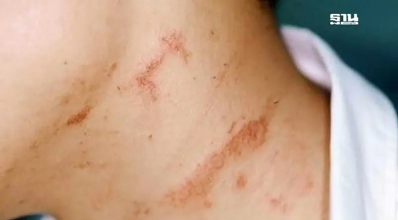 ระวัง “ผื่นแมลง” ต้นเหตุรอยดำ จากแผลอักเสบถึงชั้นผิวหนังแท้ ระวัง “ผื่นแมลง” ต้นเหตุรอยดำ จากแผลอักเสบถึงชั้นผิวหนังแท้