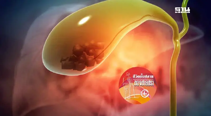 คนชรากับนิ่วในถุงน้ำดี