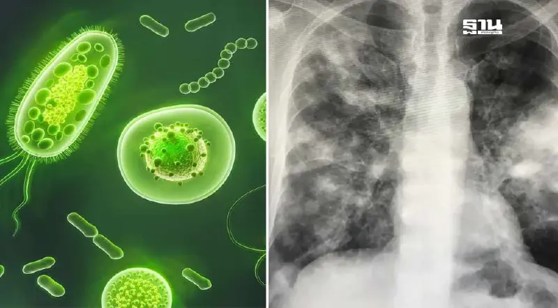 กรมควบคุมโรค เปิดข้อเท็จจริง อาการ "วัณโรคเทียม"