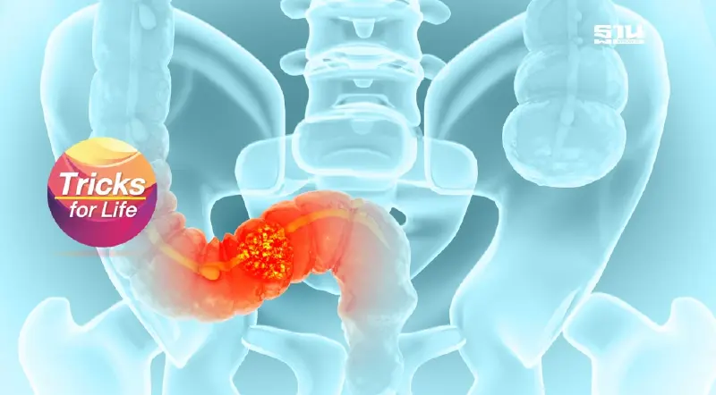 ผ่าตัด “มะเร็งลำไส้ใหญ่”  ด้วยเทคนิคส่องกล้อง MIS