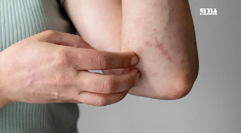 รับมือหน้าหนาว หมอแนะวิธีป้องกัน "โรคผิวแห้งเกล็ดปลา" รับมือหน้าหนาว หมอแนะวิธีป้องกัน "โรคผิวแห้งเกล็ดปลา"