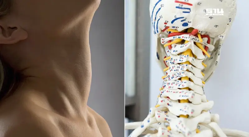 แพทย์ชี้จุด “นวดบิดคอ” หากกดทับเส้นในกระดูก C3-C5 อันตรายถึงชีวิต แพทย์ชี้จุด “นวดบิดคอ” หากกดทับเส้นในกระดูก C3-C5 อันตรายถึงชีวิต