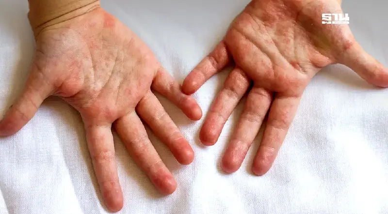 ไข้อีดำอีแดงระบาดหนักกลุ่มเด็กนักเรียน รู้จักอาการ และ วิธีรักษา