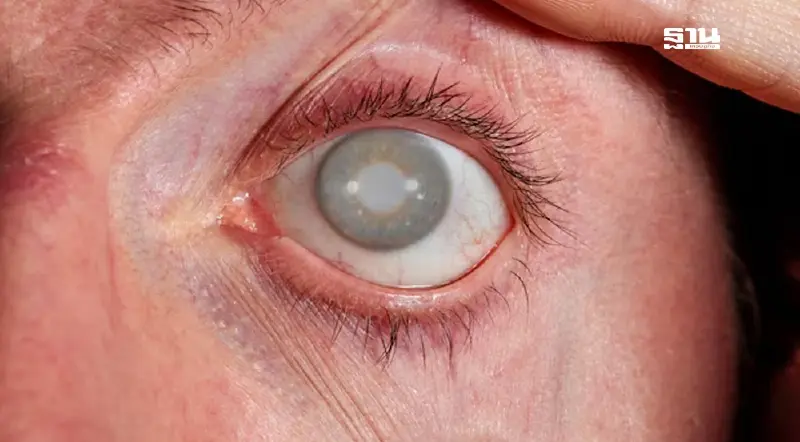 "ต้อหิน" ภัยเงียบของการมองเห็น อายุมากกว่า 50 ปีพบได้ถึง 5% "ต้อหิน" ภัยเงียบของการมองเห็น อายุมากกว่า 50 ปีพบได้ถึง 5%