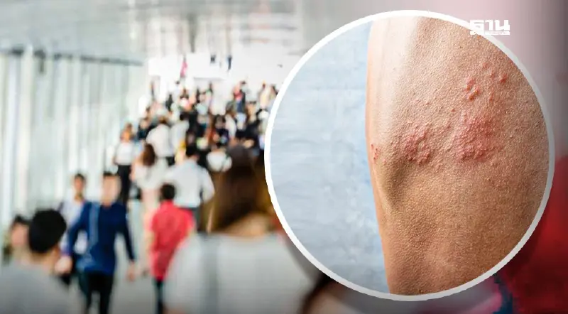 "งูสวัด" ไม่ใช่เรื่องเล็ก พบมากในผู้ป่วยมะเร็ง-ใช้ยากดภูมิ