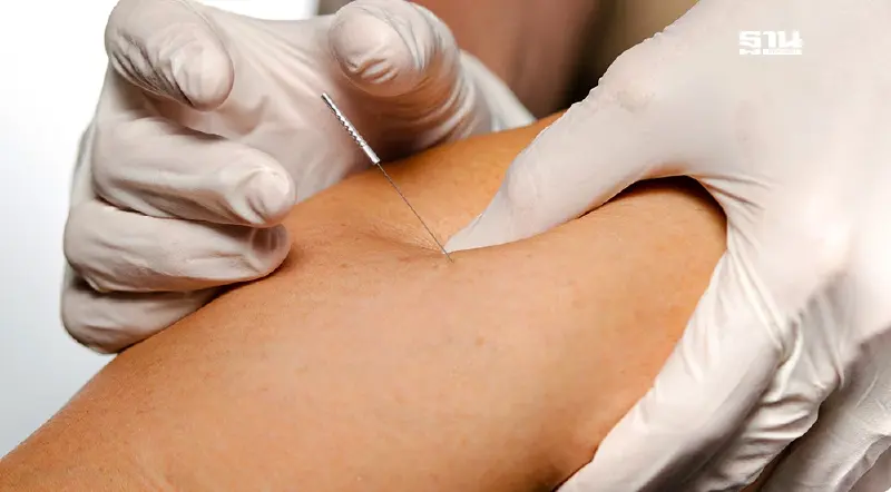 “ฝังเข็มแห้ง” ทางเลือกใหม่ “ออฟฟิศซินโดรม” โดยไม่ต้องพึ่งยา “ฝังเข็มแห้ง” ทางเลือกใหม่ “ออฟฟิศซินโดรม” โดยไม่ต้องพึ่งยา