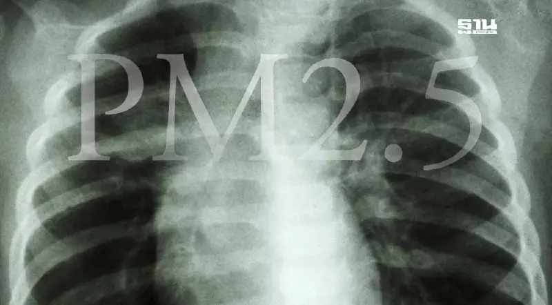 คนไทย 60% เสี่ยงมะเร็งปอดจาก PM 2.5 และตรวจพบในระยะลุกลาม