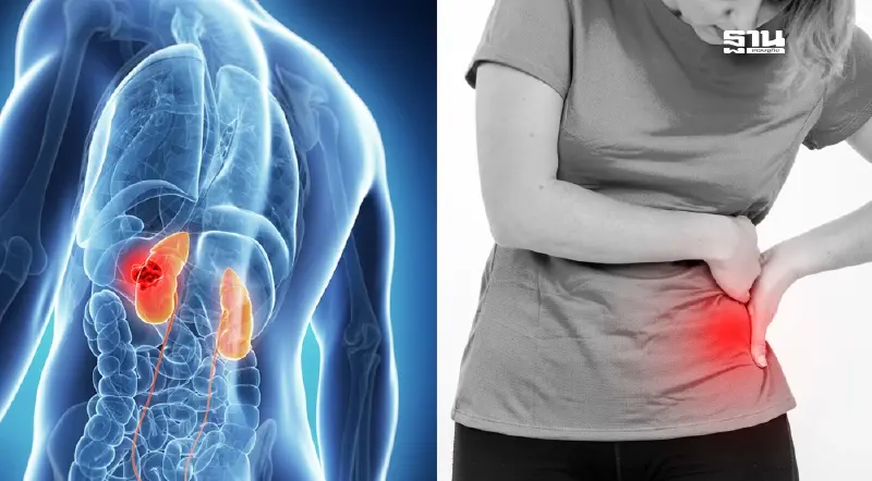 รู้จัก “มะเร็งไต” กับ 4 วิธีป้องกัน ตรวจเร็ว รักษาได้ ก่อนลุกลาม รู้จัก “มะเร็งไต” กับ 4 วิธีป้องกัน ตรวจเร็ว รักษาได้ ก่อนลุกลาม