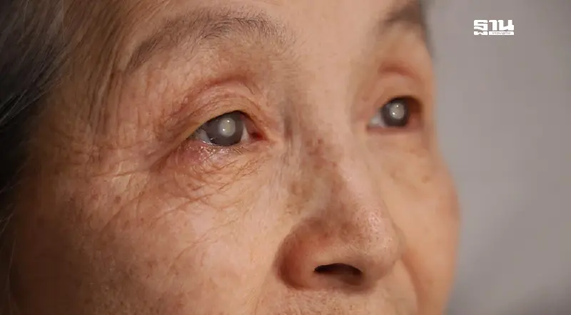 “ต้อกระจก” อาการเตือน เทคนิคการดูแล รักษาอย่างไรเพื่อไม่ให้ตาบอดถาวร “ต้อกระจก” อาการเตือน เทคนิคการดูแล รักษาอย่างไรเพื่อไม่ให้ตาบอดถาวร