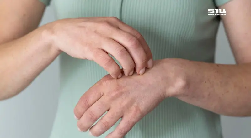 มัดรวม 'โรคผิวหนัง' ที่ต้องระวังช่วงหน้าฝน พร้อมวิธีป้องกันตัว