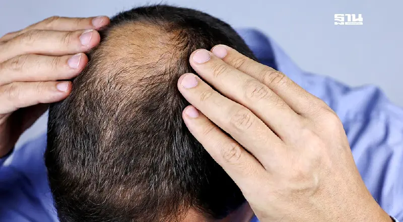 แพทย์ชี้ เครียดทำให้ “ผมร่วง-หัวล้าน” จริงหรือไม่ พร้อมวิธีรับมือและการรักษา