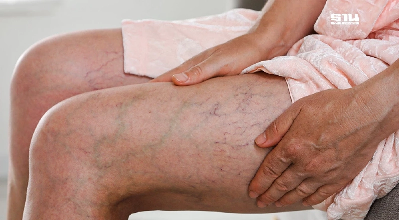 อาการป่วย “เส้นเลือดขอด-หลอดเลือดดำเสื่อม” ต้นเหตุต้องตัดขาจากแผลเรื้อรัง อาการป่วย “เส้นเลือดขอด-หลอดเลือดดำเสื่อม” ต้นเหตุต้องตัดขาจากแผลเรื้อรัง