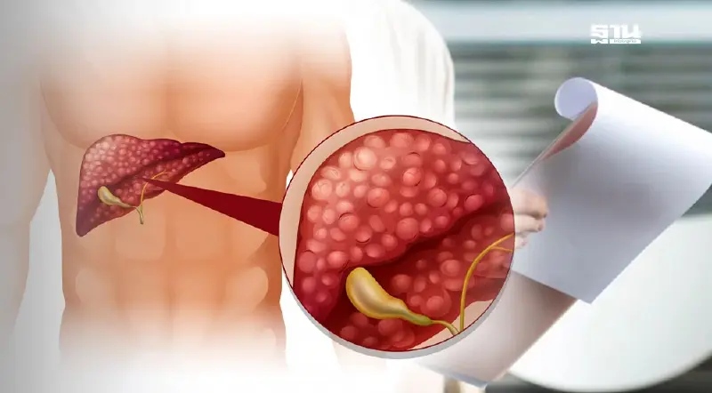 ฉีดสารกัมมันตรังสีผ่านหลอดเลือดแดง ทางเลือกใหม่รักษา มะเร็งตับ ฉีดสารกัมมันตรังสีผ่านหลอดเลือดแดง ทางเลือกใหม่รักษา มะเร็งตับ