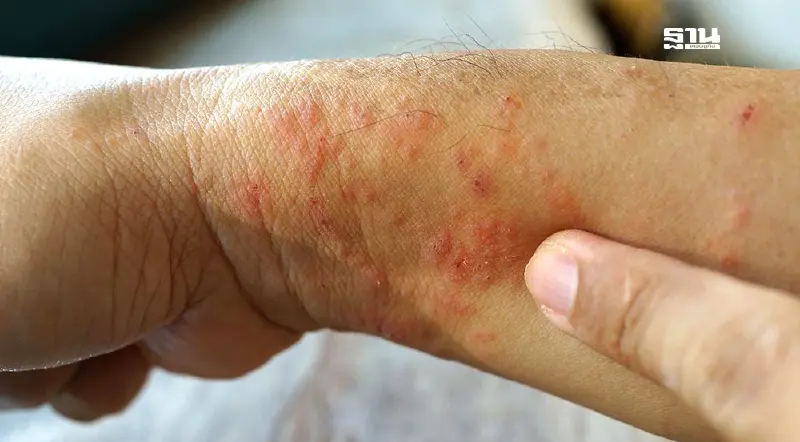 โรคไข้ดิน อาการ และสาเหตุ หลังพบเสียชีวิต 92 ราย