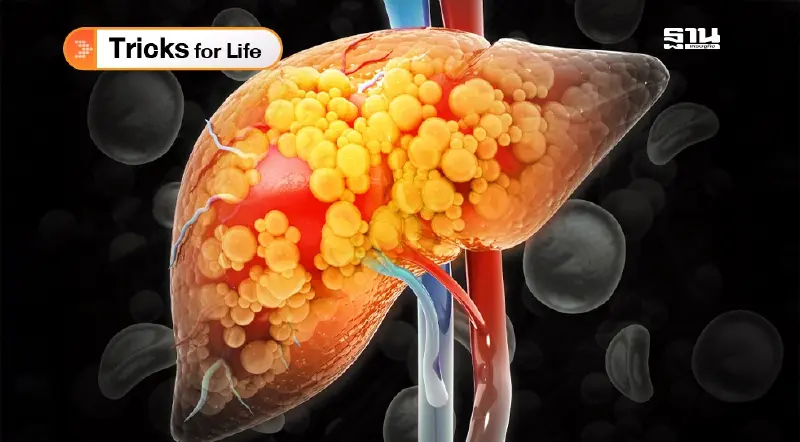 ไขมันพอกตับ ไม่ใช่เรื่องไกลตัว ไขมันพอกตับ ไม่ใช่เรื่องไกลตัว