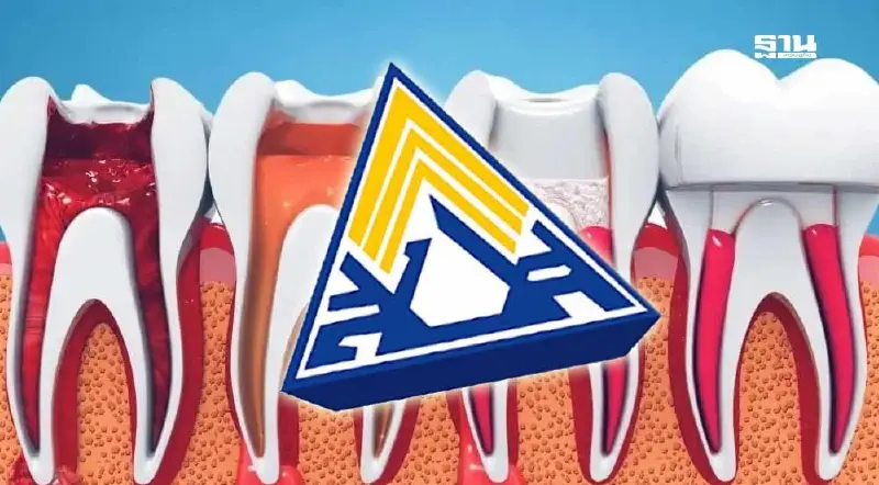 'ผ่าฟันคุด-ฝังรากเทียม' ไม่ต้องจ่ายเพิ่ม 'บอร์ด สปส.'เพิ่มสิทธิทันตกรรม 'ผ่าฟันคุด-ฝังรากเทียม' ไม่ต้องจ่ายเพิ่ม 'บอร์ด สปส.'เพิ่มสิทธิทันตกรรม