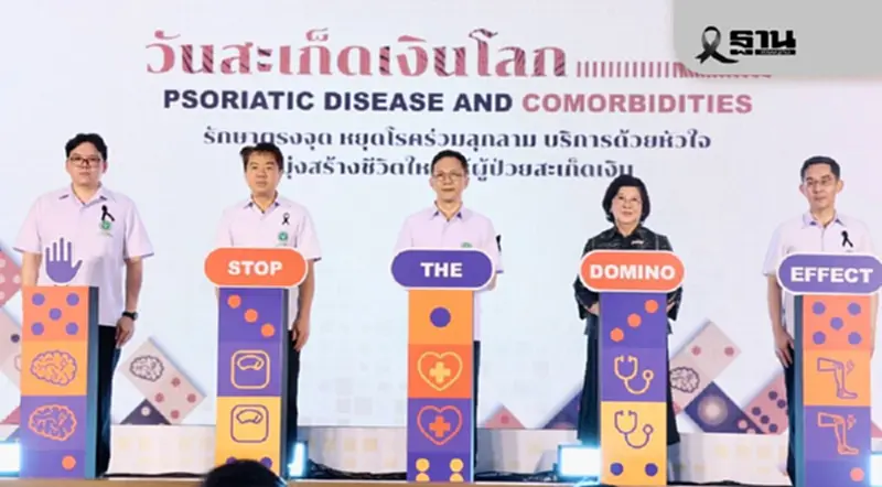 'โรคสะเก็ดเงิน' กระทบสุขภาพ รักษาตรงจุด หยุดโรคร่วมลุกลาม 'โรคสะเก็ดเงิน' กระทบสุขภาพ รักษาตรงจุด หยุดโรคร่วมลุกลาม