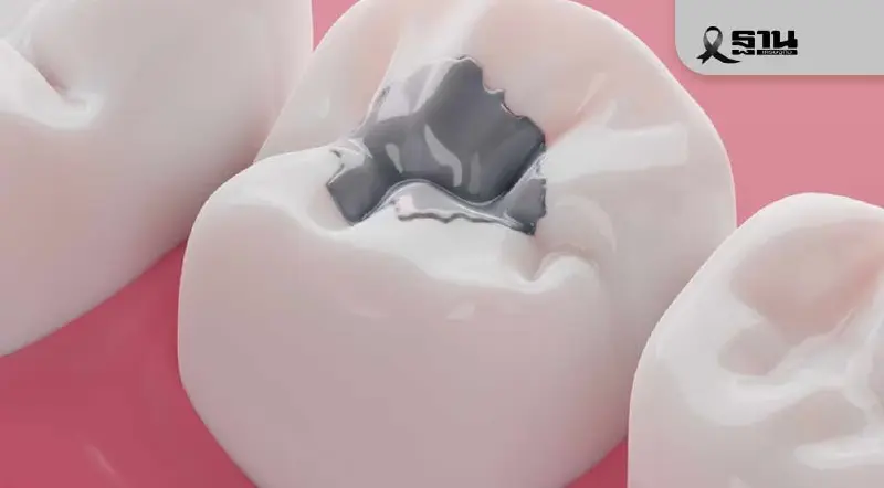 ทั่วโลกตกลงห้ามใช้ “วัสดุอุดฟันปรอท” สิ้นสุดปี 2577 ลดพิษโลหะหนัก ทั่วโลกตกลงห้ามใช้ “วัสดุอุดฟันปรอท” สิ้นสุดปี 2577 ลดพิษโลหะหนัก