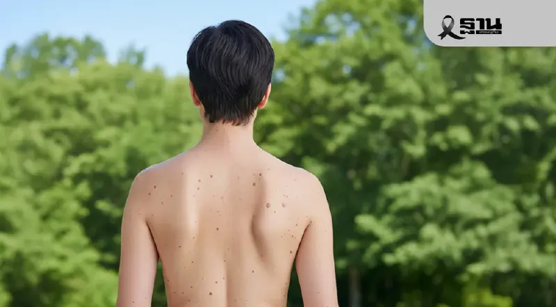 แพทย์ชี้ “มะเร็งผิวหนัง” พบเร็ว รักษาเร็ว โอกาสหายขาดสูง