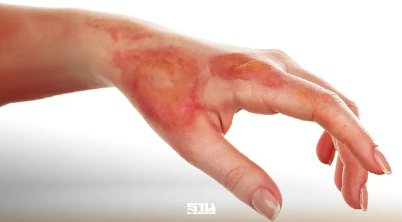 อาการ ‘ไข้กาฬหลังแอ่น’ โรคติดเชื้ออันตรายที่ชื่อน่ากลัว ระบาดอังกฤษดับแล้ว 2 คน