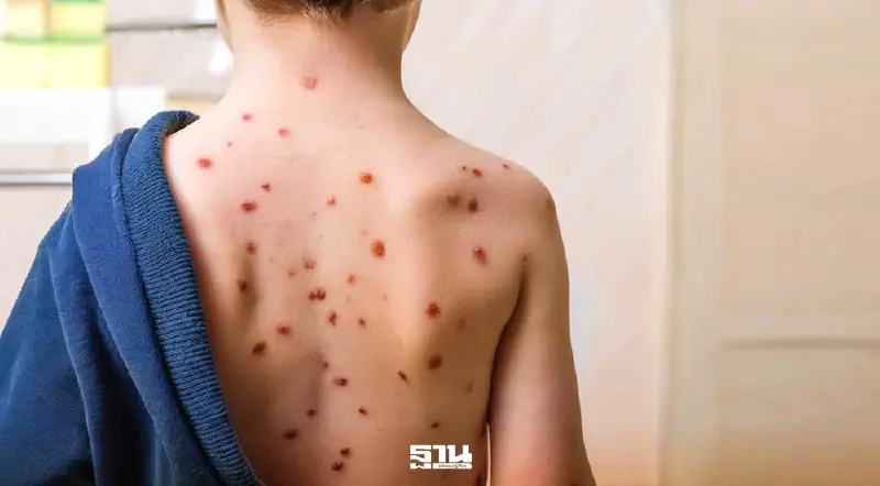 เช็กอาการ-การติดต่อ- กลุ่มเสี่ยงต้องเฝ้าระวัง 'อีสุกอีใส' เช็กอาการ-การติดต่อ- กลุ่มเสี่ยงต้องเฝ้าระวัง 'อีสุกอีใส'