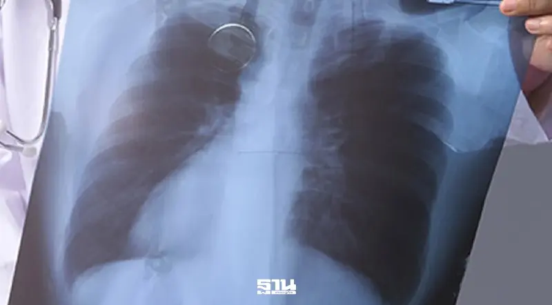 สปสช. เห็นชอบข้อเสนอแก้ปัญหา วัณโรคครบวงจร เร่งขยายคัดกรองเชิงรุก