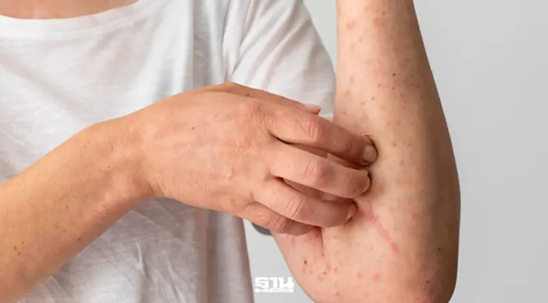 กรมควบคุมโรค เฝ้าระวังโรค Mpox สายพันธุ์ Clade Ib กลุ่มเสี่ยง กรมควบคุมโรค เฝ้าระวังโรค Mpox สายพันธุ์ Clade Ib กลุ่มเสี่ยง
