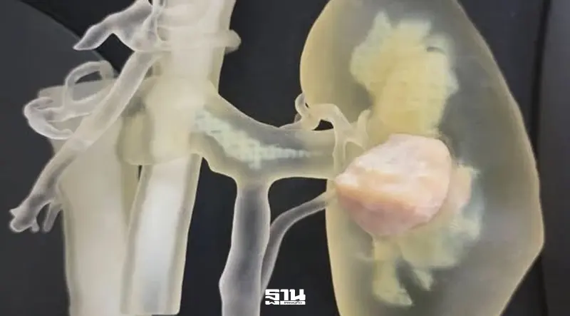 รพ.เลิดสิน ชูนวัตกรรมหุ่นยนต์-3D ปฏิวัติการผ่าตัดมะเร็งไต
